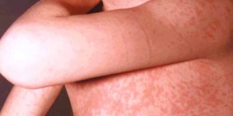 Preocupación por la posible expansión del sarampión durante el Mundial