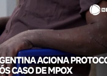 Se registraron 4 nuevos casos de Mpox y totalizan 15 en el año