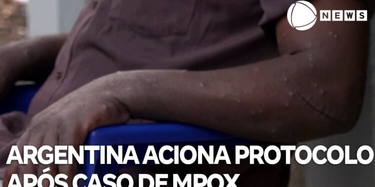 Se registraron 4 nuevos casos de Mpox y totalizan 15 en el año